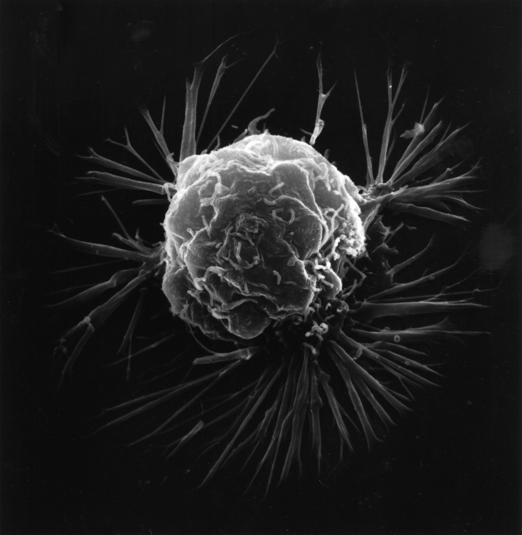 HR-Positive, HER2-Negative Breast Cancer: Symptoms, Causes and Treatment
